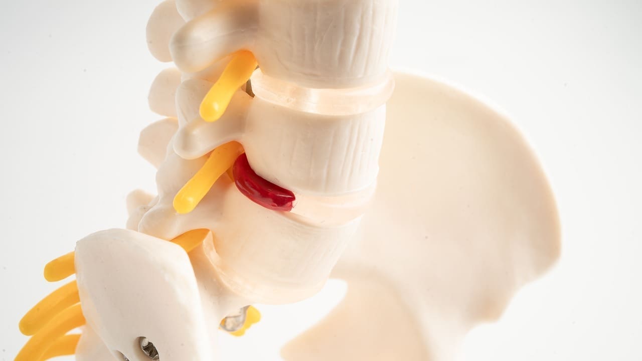 11 Herniated Disk Images: What Slipped, Ruptured, and Bulging Discs Look Like 1 11 Herniated Disk Images: What Slipped, Ruptured, and Bulging Discs Look Like