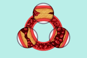 What Causes Plaque to Form in Arteries Naturally