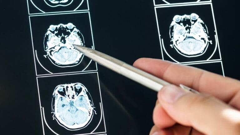 Brain X Ray: 7 Key Facts About X-Ray Imaging of the Human Brain