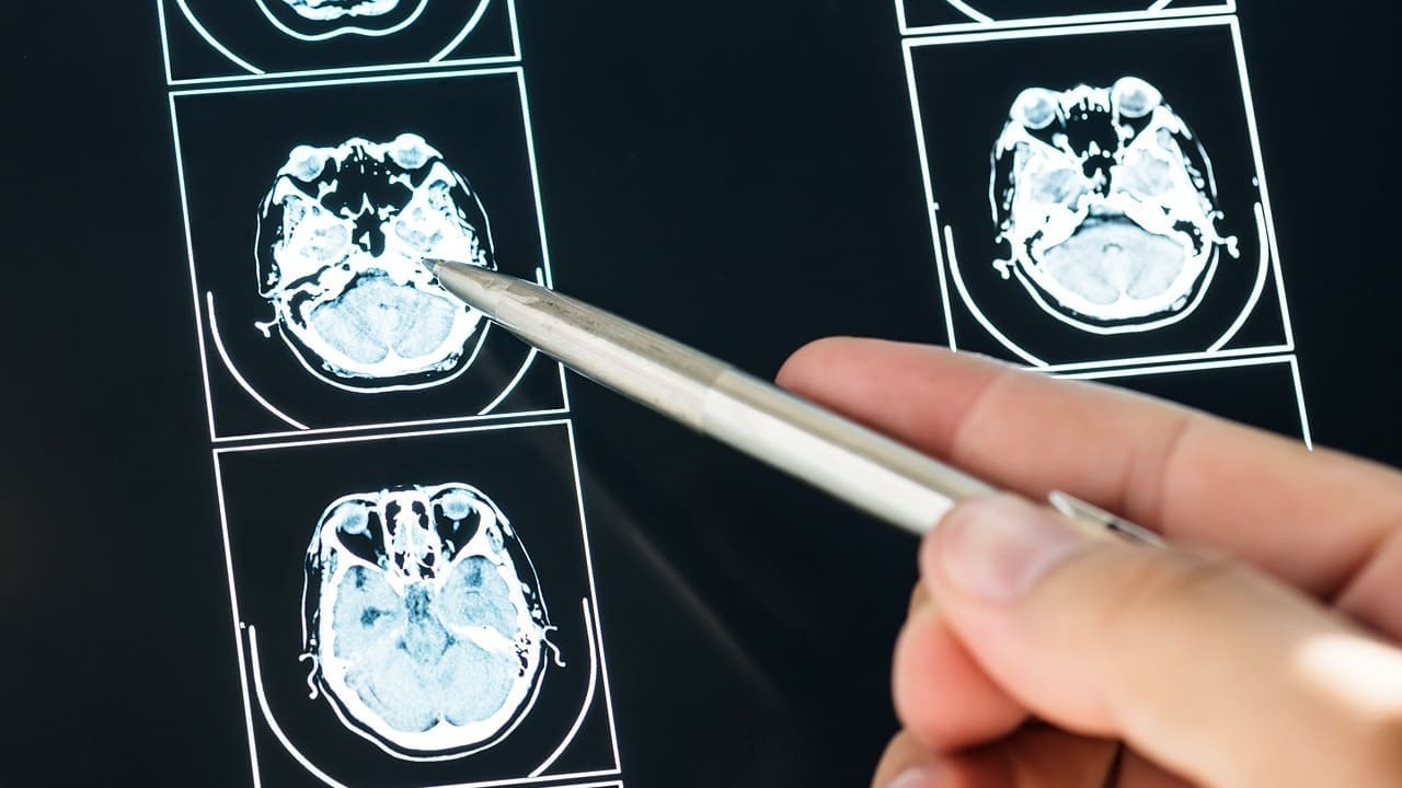 Brain X Ray: 7 Key Facts About X-Ray Imaging of the Human Brain