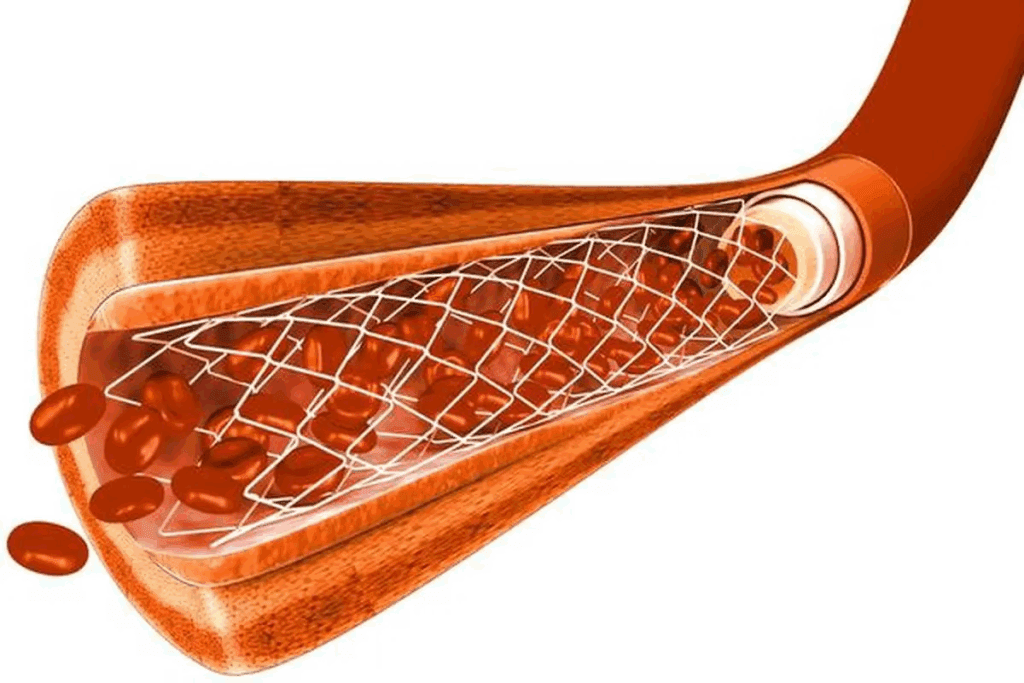 Heart Stent Procedure Video: Step Guide