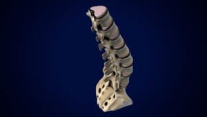 Understanding the Difference Between a Disc Bulge and a Slipped (Herniated) Disc