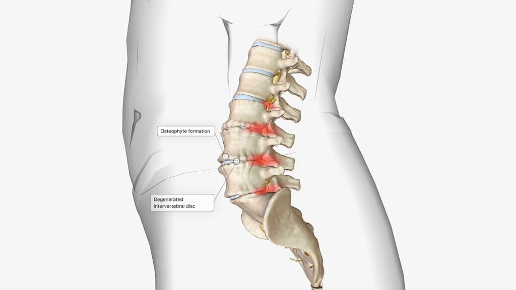 slipped vs herniated disc