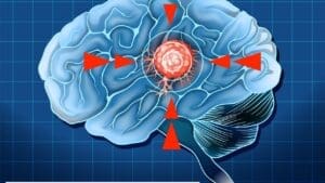 What Are the Symptoms and Risks of a Calcified Meningioma Brain Tumor?