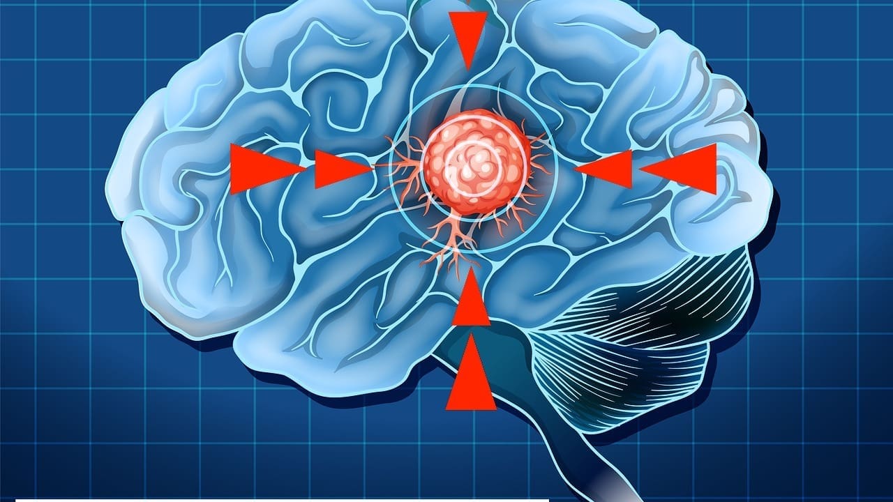 meningioma calcified brain tumor LIV Hospital