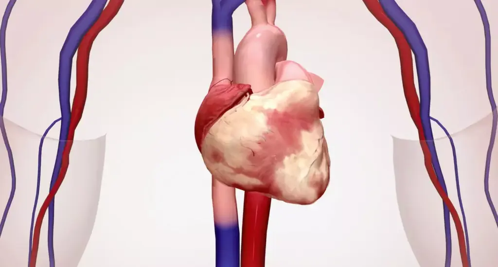 Detailed anatomical diagram of the human heart, showcasing the myocardial infarction. Precise illustration of the coronary circulation, with emphasis on the affected blood vessels and the damaged myocardial tissue. Crisp, technical rendering with a clean, neutral background, highlighting the key structures in a clear, informative manner. Soft, directional lighting from the top-left, casting subtle shadows to accentuate the three-dimensional form. Detailed cross-section view, captured at a slight angle to provide optimal visibility. Muted color palette, focusing on shades of red, blue, and gray to convey the medical subject matter. Overall, a comprehensive, visually striking representation suitable for educational purposes. Detailed anatomical diagram of the human heart, showcasing the myocardial infarction. Precise illustration of the coronary circulation, with emphasis on the affected blood vessels and the damaged myocardial tissue. Crisp, technical rendering with a clean, neutral background, highlighting the key structures in a clear, informative manner. Soft, directional lighting from the top-left, casting subtle shadows to accentuate the three-dimensional form. Detailed cross-section view, captured at a slight angle to provide optimal visibility. Muted color palette, focusing on shades of red, blue, and gray to convey the medical subject matter. Overall, a comprehensive, visually striking representation suitable for educational purposes.