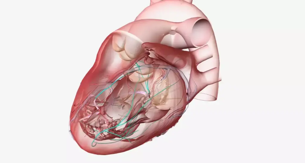 A detailed, cross-sectional view of a human heart experiencing a myocardial infarction. In the foreground, the heart muscle is shown to be damaged and discolored, with areas of ischemia and necrosis. The coronary arteries are occluded, preventing oxygen-rich blood from reaching the affected region. In the middle ground, the pericardium and surrounding tissues are inflamed, with visible signs of edema and fluid buildup. The background is a clean, clinical environment, with soft, directional lighting illuminating the scene from an angle that emphasizes the three-dimensional structure of the heart. The overall mood is one of medical urgency and the need for immediate intervention to restore blood flow and prevent further damage. A detailed, cross-sectional view of a human heart experiencing a myocardial infarction. In the foreground, the heart muscle is shown to be damaged and discolored, with areas of ischemia and necrosis. The coronary arteries are occluded, preventing oxygen-rich blood from reaching the affected region. In the middle ground, the pericardium and surrounding tissues are inflamed, with visible signs of edema and fluid buildup. The background is a clean, clinical environment, with soft, directional lighting illuminating the scene from an angle that emphasizes the three-dimensional structure of the heart. The overall mood is one of medical urgency and the need for immediate intervention to restore blood flow and prevent further damage.