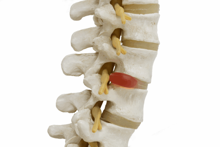 Do cortisone shots help herniated disc? 7 Key Facts