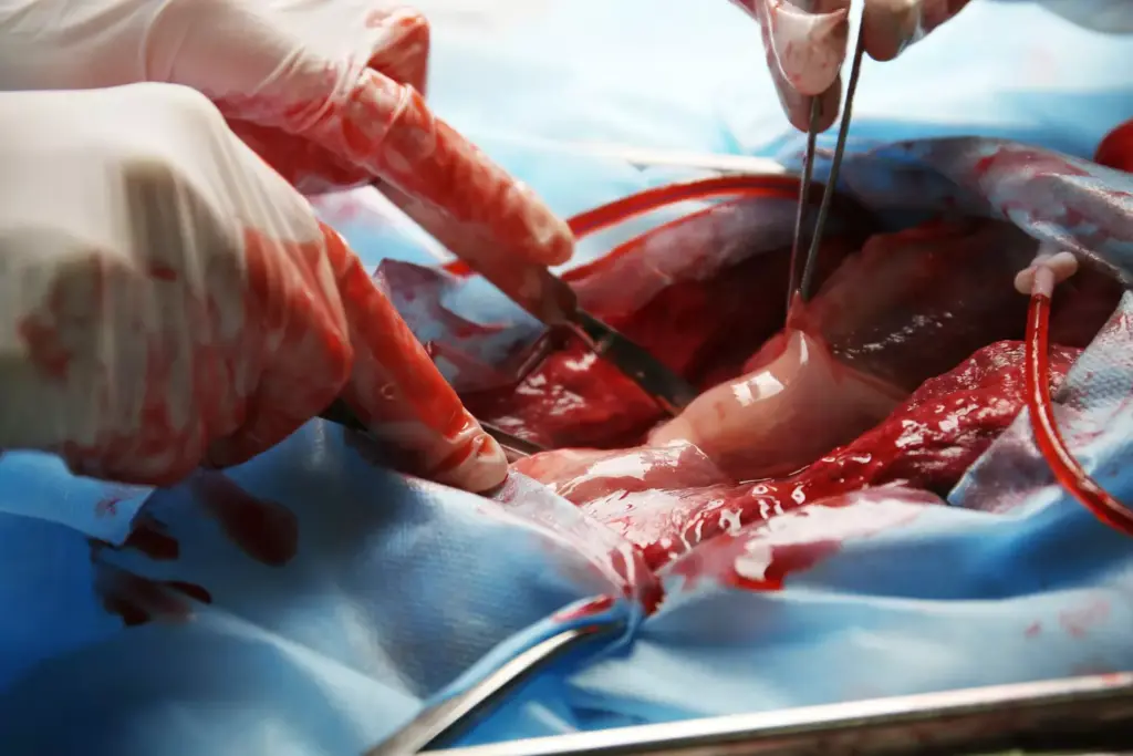 Mildly Dilated Aortic Root Mildly Dilated Aortic Root