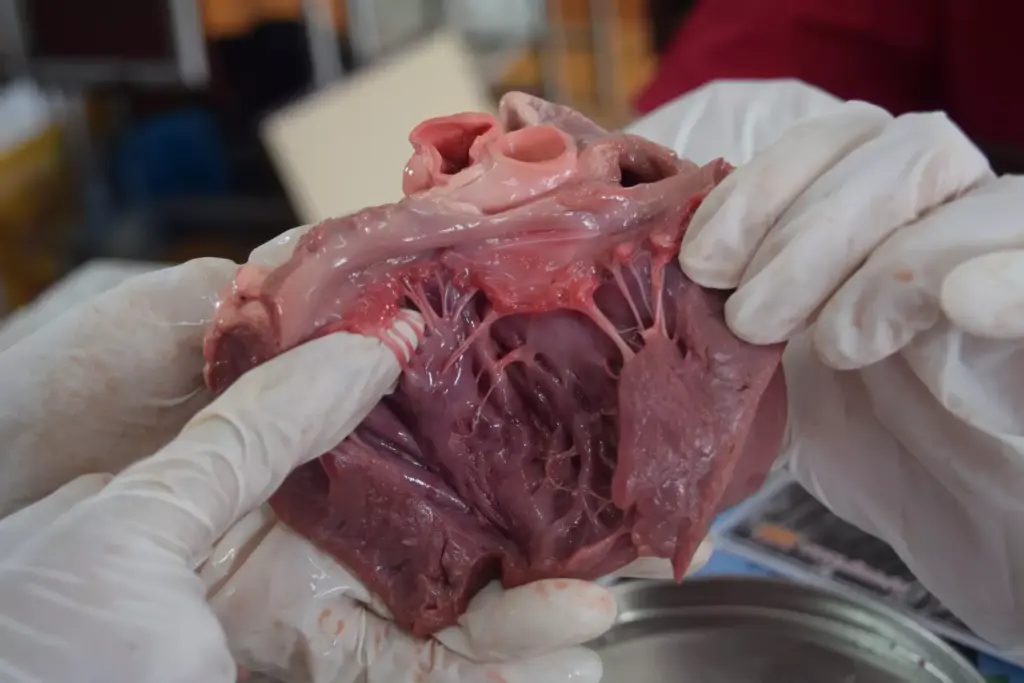 What Does a Mildly Dilated Aortic Root and Ascending Aorta Mean for Your Health? 1 What Does a Mildly Dilated Aortic Root and Ascending Aorta Mean for Your Health?