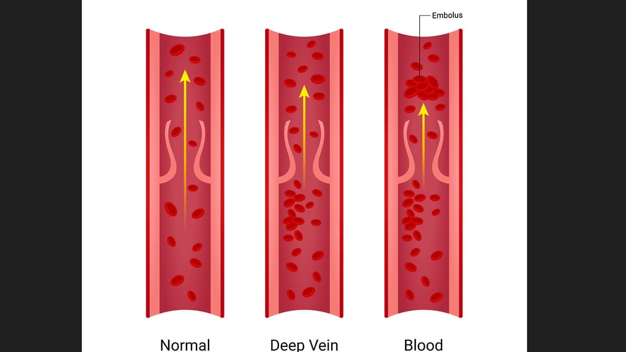 7 Key Facts About Thrombosis Occlusion and Their Clinical Impacts 1 thrombosis occlusion LIV Hospital