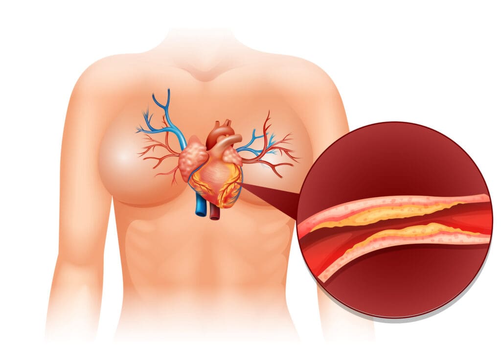 angina pectoris