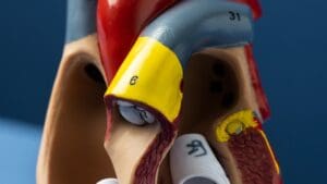 What Is a Calcified Aortic Valve and How Is Mild Calcification Managed?