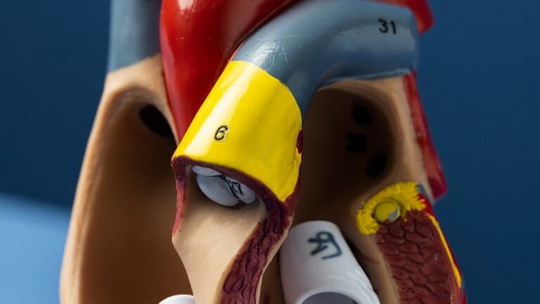 What Is a Calcified Aortic Valve and How Is Mild Calcification Managed?