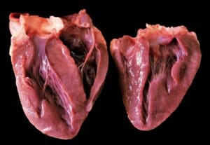 What Does It Mean When the Aortic Valve Is Calcified, and How Is It Treated?