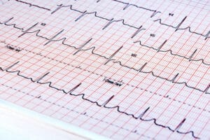 7 Essential Angina ECG Changes: How to Recognize Stable and Unstable Patterns