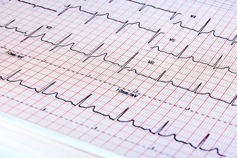 7 Essential Angina ECG Changes: How to Recognize Stable and Unstable Patterns 1 7 Essential Angina ECG Changes: How to Recognize Stable and Unstable Patterns