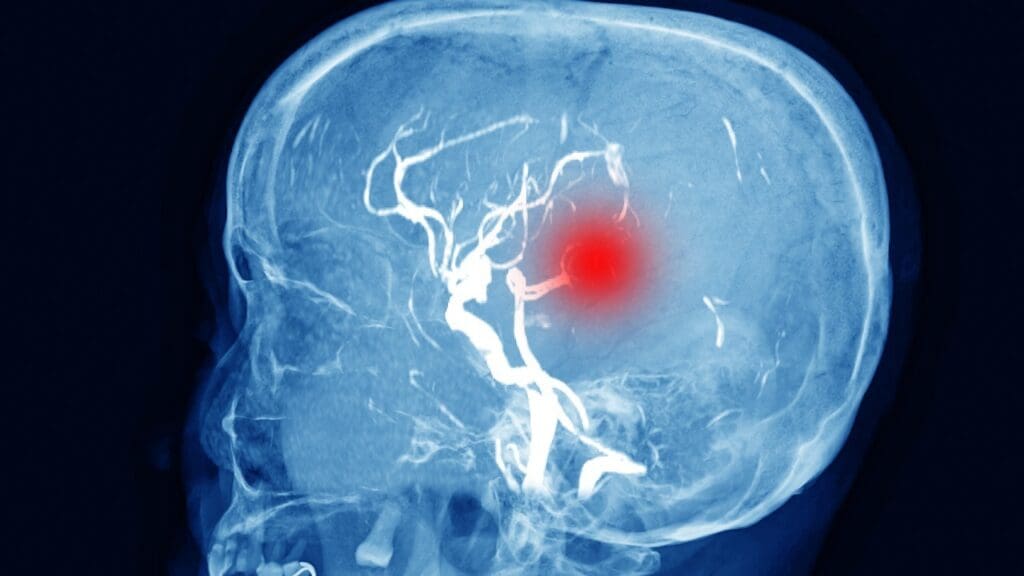 Meningioma Tumor Locations