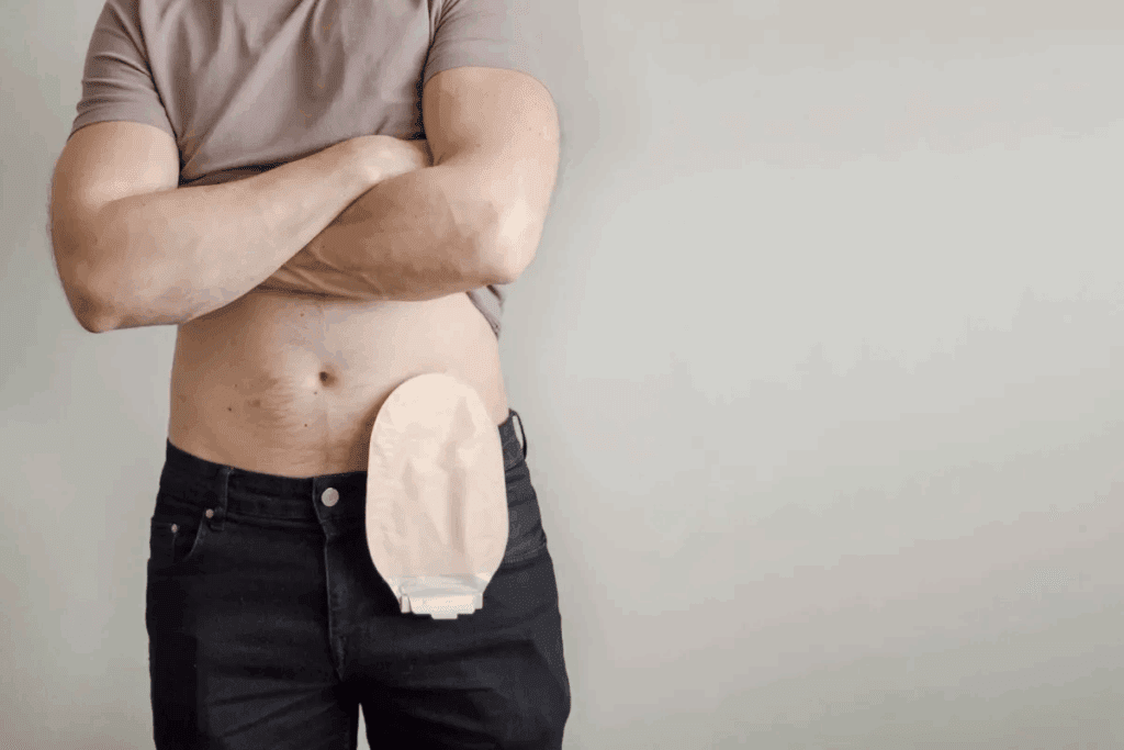 How Does a Colostomy Bag Work? Explained 2 How Does a Colostomy Bag Work? Explained