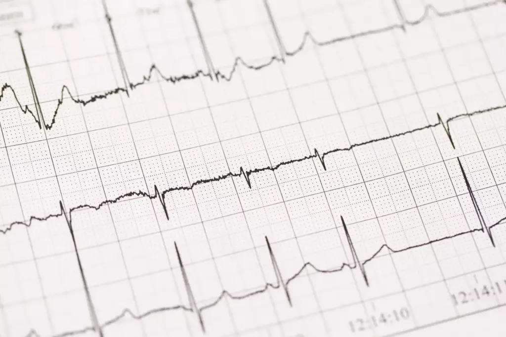 Understanding Atrial Fibrillation