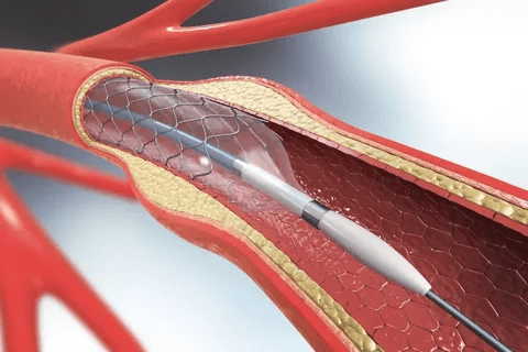 How Many Heart Stents Can a Person Have? Key Facts