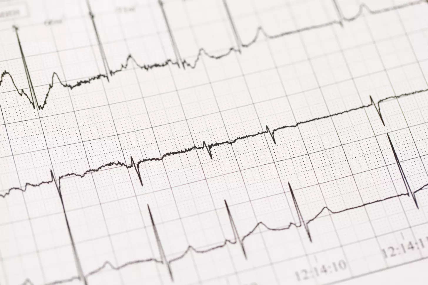 7 Key Facts About Atrial Fib Stroke Risk You Need to Know