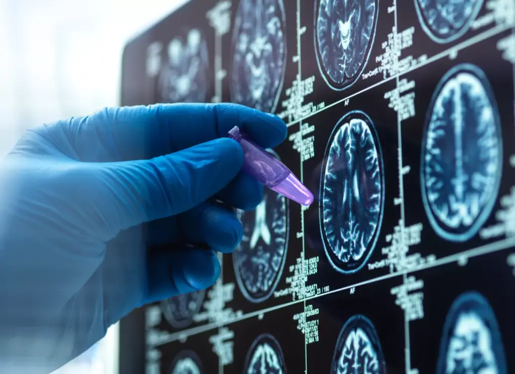 Understanding Atrial Fibrillation Understanding Atrial Fibrillation