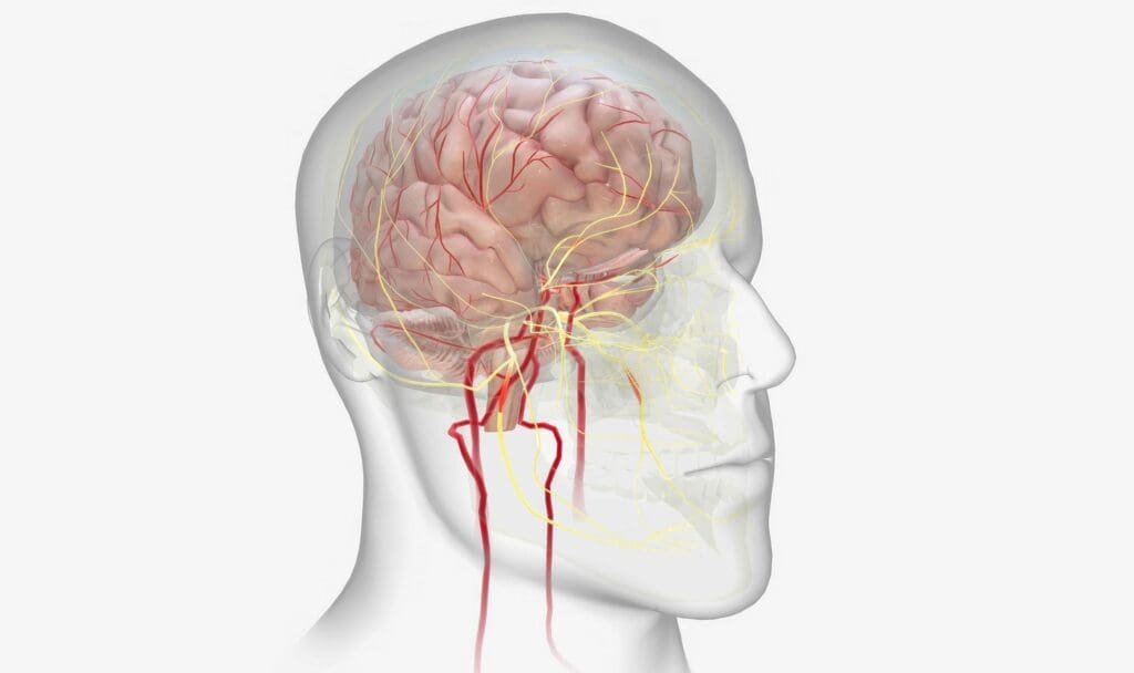 Detailed cross-sectional diagram of an arteriovenous malformation (AVM) in the human brain