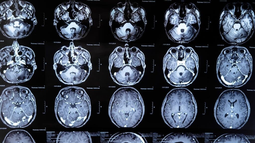 cerebral edema pathophysiology cerebral edema pathophysiology