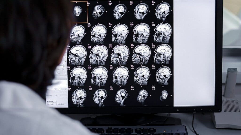 brain tumor classification