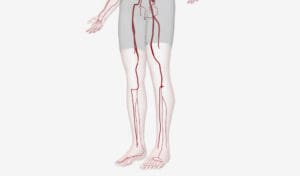 7 Key Facts About Popliteal Artery Aneurysm Symptoms and Treatment