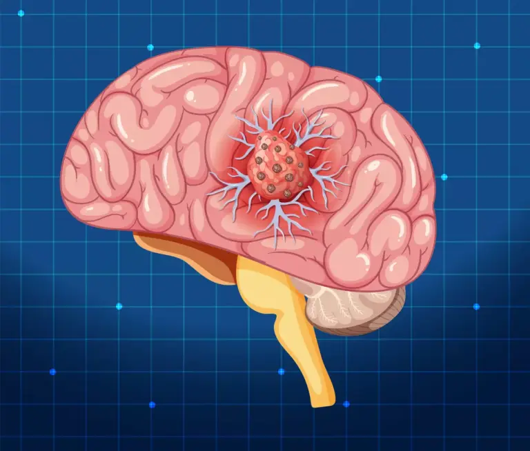 Benign Brain Tumor Symptoms: 10 Key Signs and What to Watch For