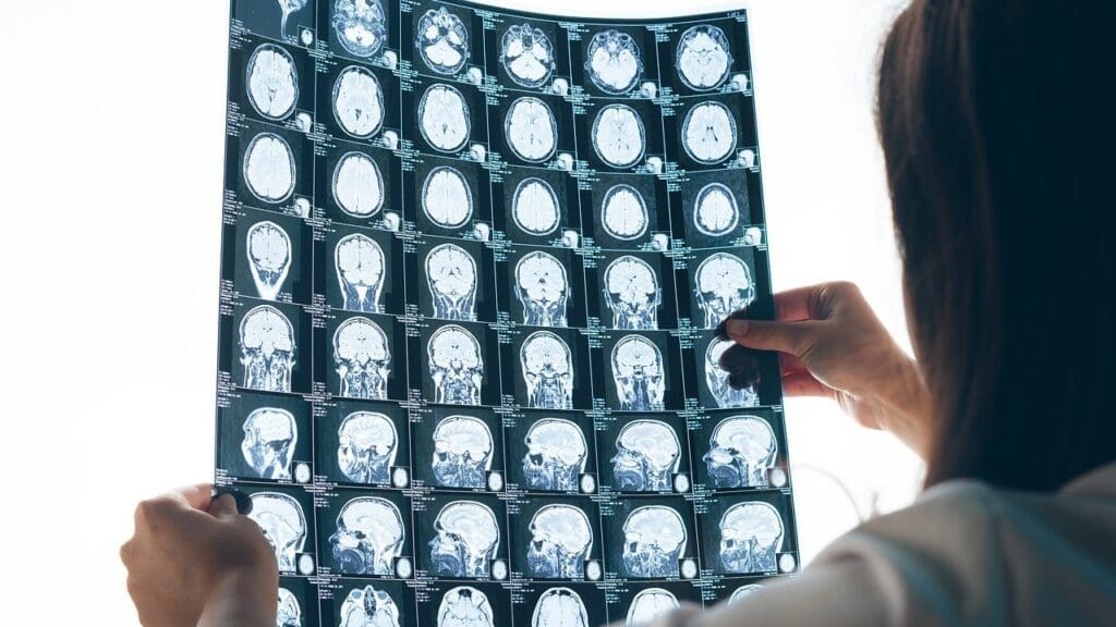 Brain Stem Tumor Symptoms Brain Stem Tumor Symptoms