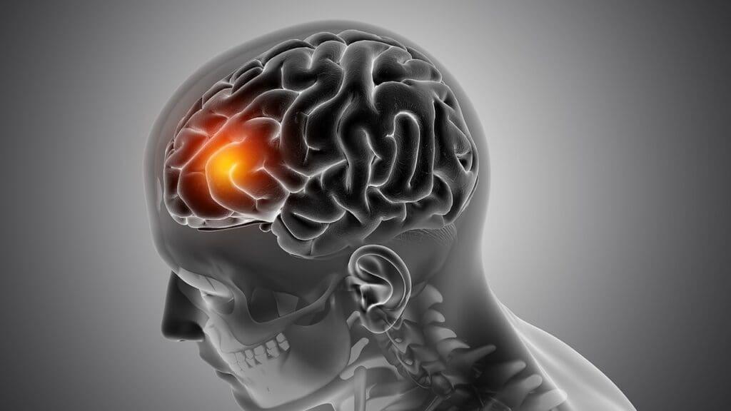 brain stem tumors Critical Location