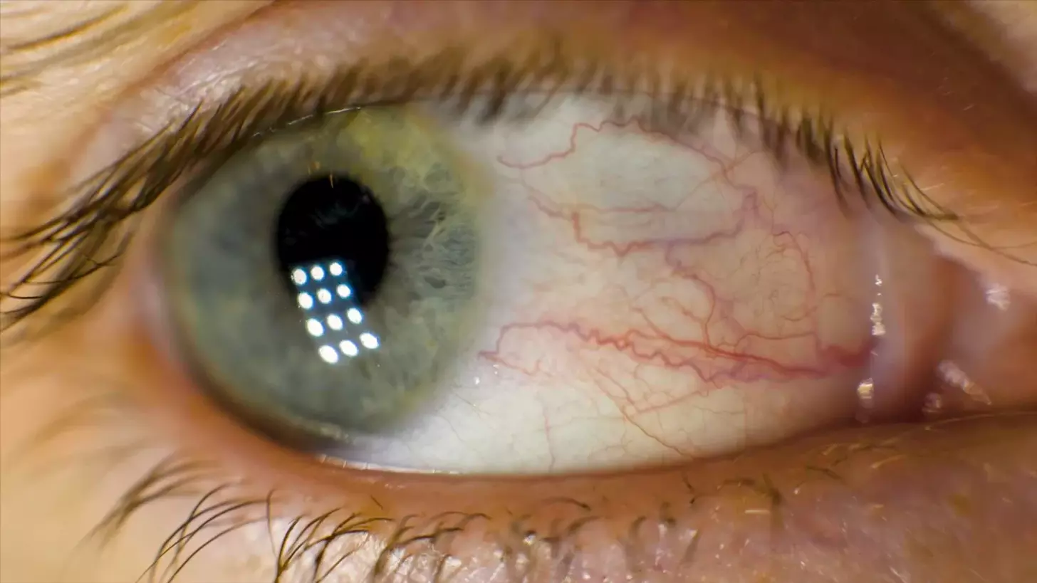 Brain Tumor Vision Changes: 8 Key Symptoms and Warning Signs to Know