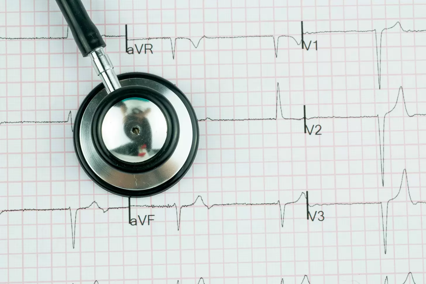 7 Key Facts About Irregular Sinus Rhythm and Sinus Arrhythmia 1 7 Key Facts About Irregular Sinus Rhythm and Sinus Arrhythmia