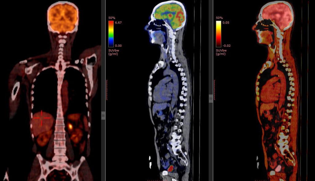 Pet,Ct,Scan,Of,Human,Body,(,Positron,Emission,Tomography)