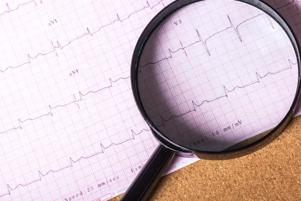 What Is Sinus Arrhythmia?