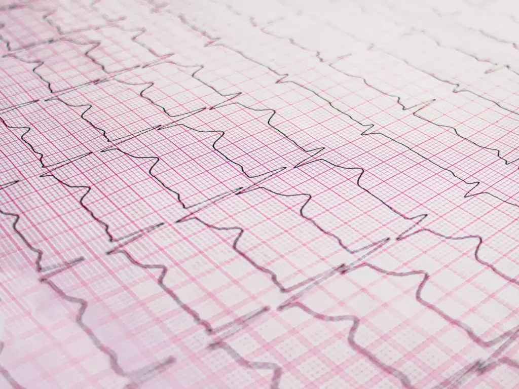 Normal Sinus Rhythm vs. Sinus Arrhythmia Normal Sinus Rhythm vs. Sinus Arrhythmia