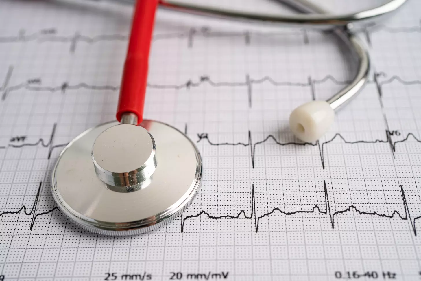 Sinus Rhythm Arrhythmia: 7 Key Differences, Causes, and ECG Findings 1 Sinus Rhythm Arrhythmia: 7 Key Differences, Causes, and ECG Findings