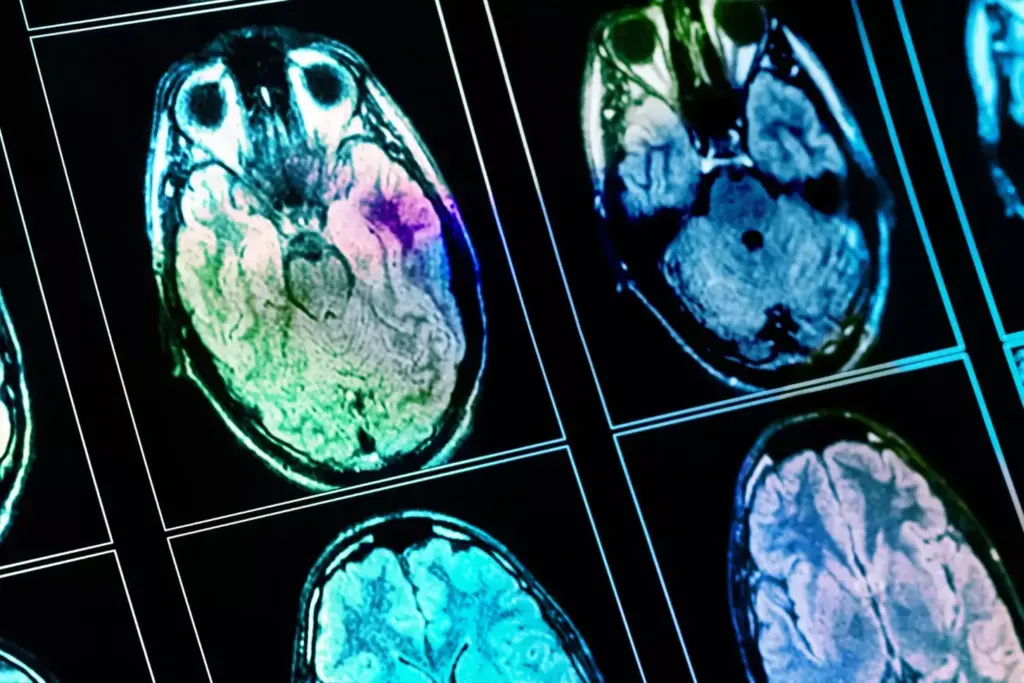 A detailed cross-section of the human brain, prominently displaying various types of brain tumors in lifelike detail. The tumors are shown in a range of sizes, shapes, and locations, accurately depicting their impact on the surrounding brain tissue. The image has a clinical, scientific feel, with a muted color palette and precise anatomical rendering. Lighting is soft and directional, creating depth and emphasizing the three-dimensional structure of the brain. The composition places the tumors in the foreground, with the surrounding healthy brain matter visible in the middle and background. The overall mood is informative and educational, conveying the importance of understanding brain tumors and their effects.
