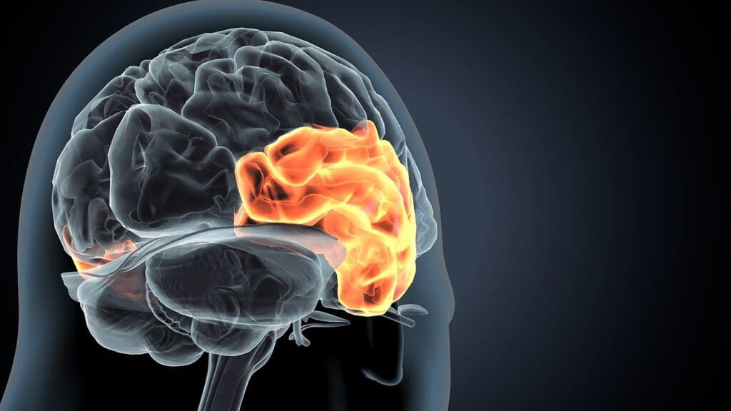 What Are Brain Stem Tumors