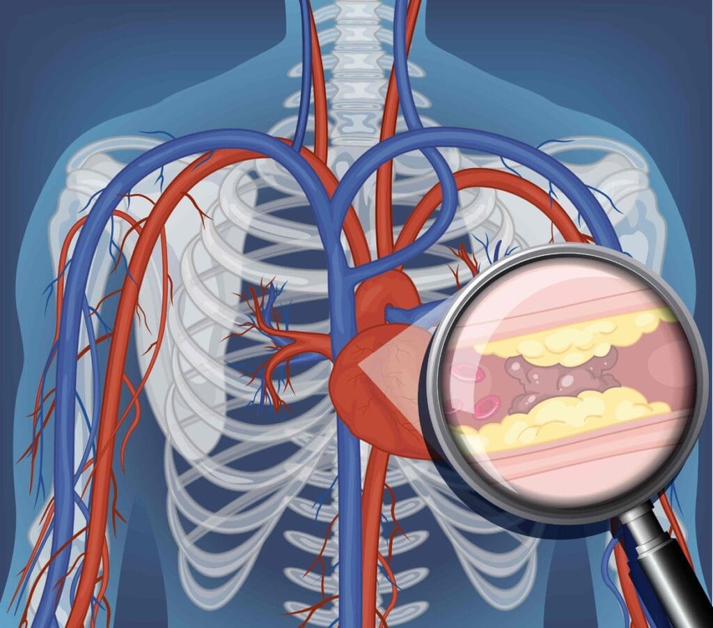 A detailed cross-section diagram depicting the anatomy and pathophysiology of an arteriovenous malformation.