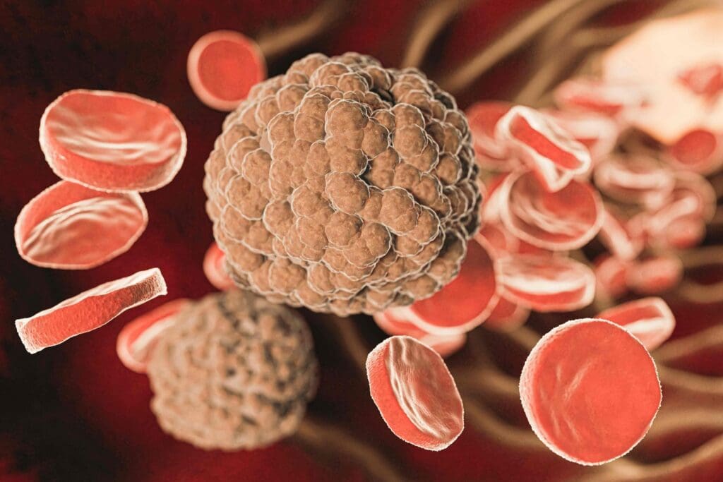 A detailed cross-sectional view of an arteriovenous malformation (AVM)