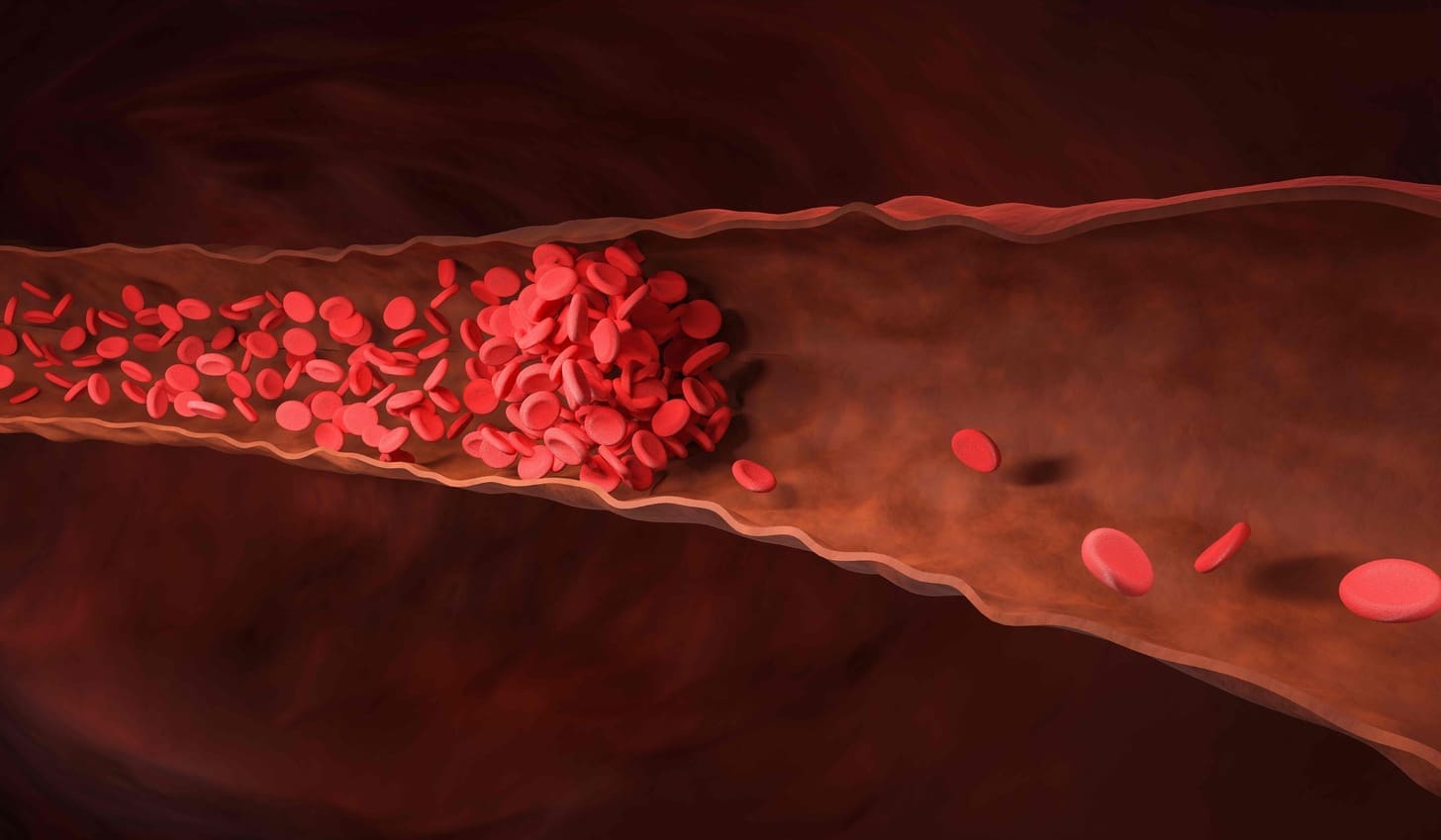What Is an Arteriovenous Malformation and How Does It Affect the Skin or Leg?