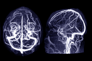 What Is coiling of artery and How Does It Treat Brain Aneurysms?