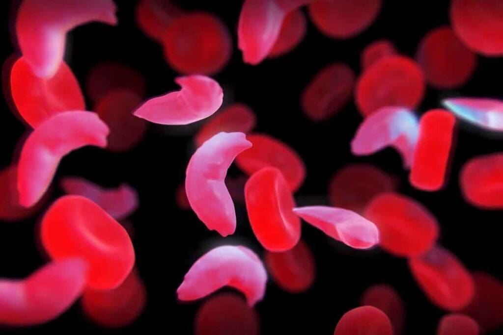 Sickle Cell Anemia Treatment: 7 Options 3 Sickle Cell Anemia Treatment: 7 Options