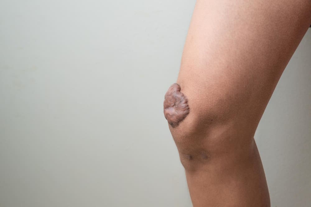 10 Types of Benign Tumors and Non-Cancerous Lumps in the Leg Explained