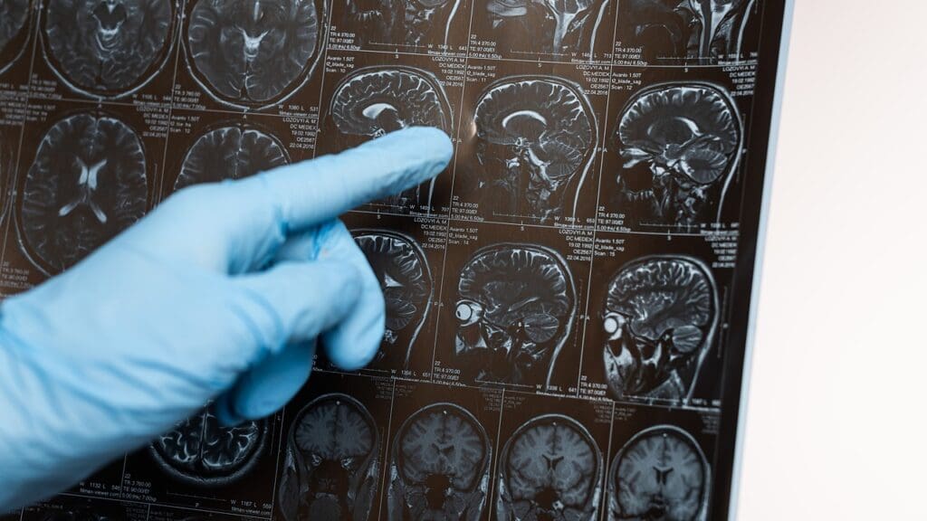 types of brain cysts types of brain cysts