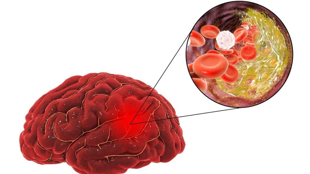 What Is a Cyst on the Brain Stem and How Does It Affect You?
